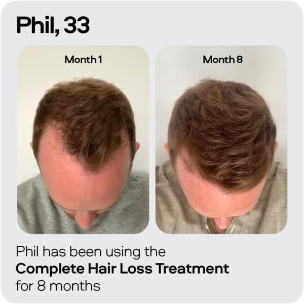 Sons Minoxidil 5% Cutaneous Solution - Precision Application - 3 Month Supply in Reduced Packaging - Image 2