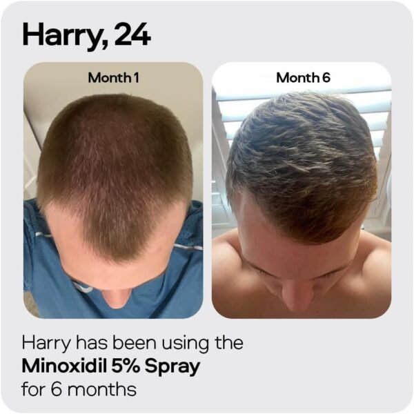 Sons Minoxidil 5% Cutaneous Solution - Precision Application - 3 Month Supply in Reduced Packaging - Image 3