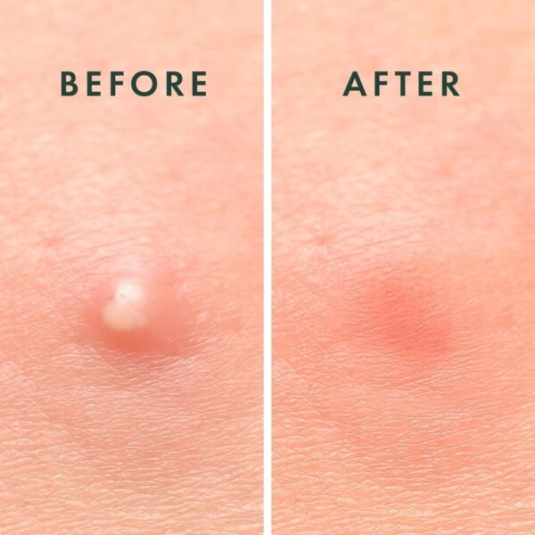 Rael Pimple Patches, Miracle Invisible Spot Cover - Korean Skincare, Hydrocolloid Acne Spot Treatment Patch - 2 Sizes (96 Patches) - Image 5
