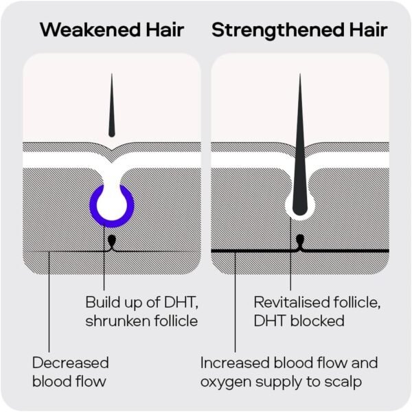 Sons Minoxidil 5% Cutaneous Solution - Precision Application - 3 Month Supply in Reduced Packaging - Image 4